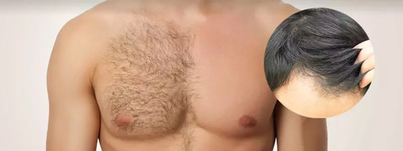 Body-hair-transplantation