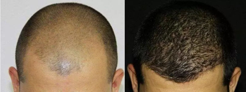 Stem-cell-FUE-hair-transplant
