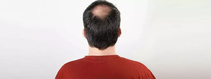 Crown-hair-transplant