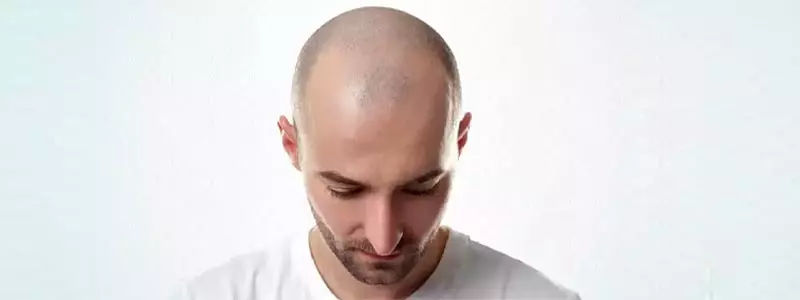 Hair-transplant-with-Acell-PRP