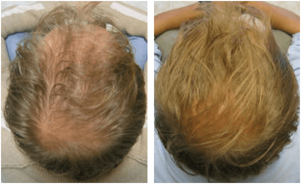 Alopecia treatment in germany. MESOTOX Scalp solution. Matrigen MESOTOX Scalp. Скальп-терапия своими руками. Masajor Scalp MD.