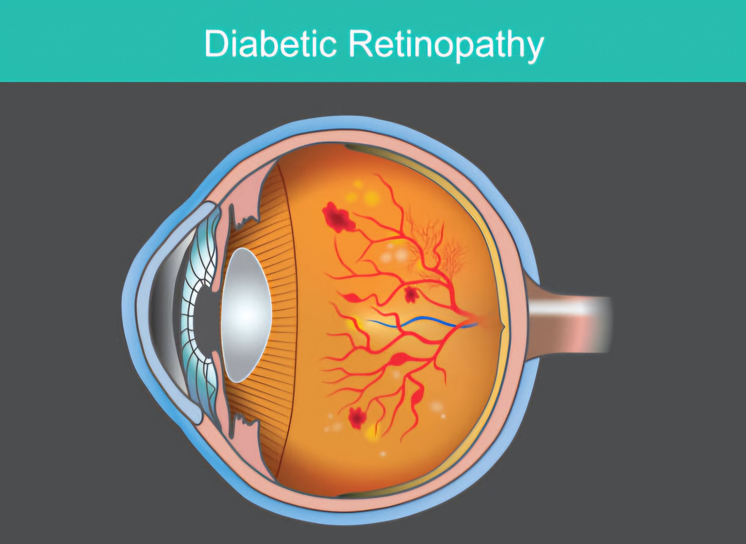Diabetic retinopathy stages and symptoms that need urgent help! 