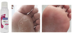 Footlogix Peeling skin formula (huidschimmel) - Moorsele