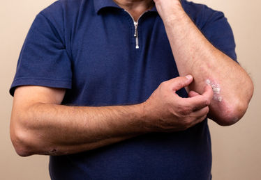 Man scratching dermatitis