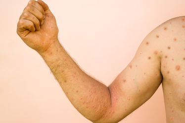 Man with red rash on arm and body