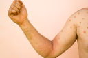 Man with red rash on arm and body