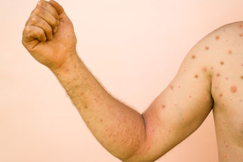 Man with red rash on arm and body