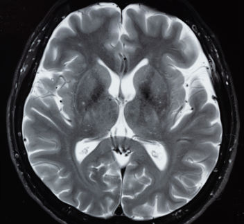 A normal MRI scan of the human brain