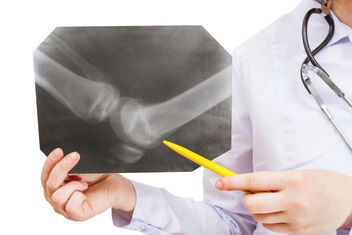 A nurse shows X-ray picture with human knee joint