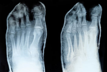 x-ray of feet