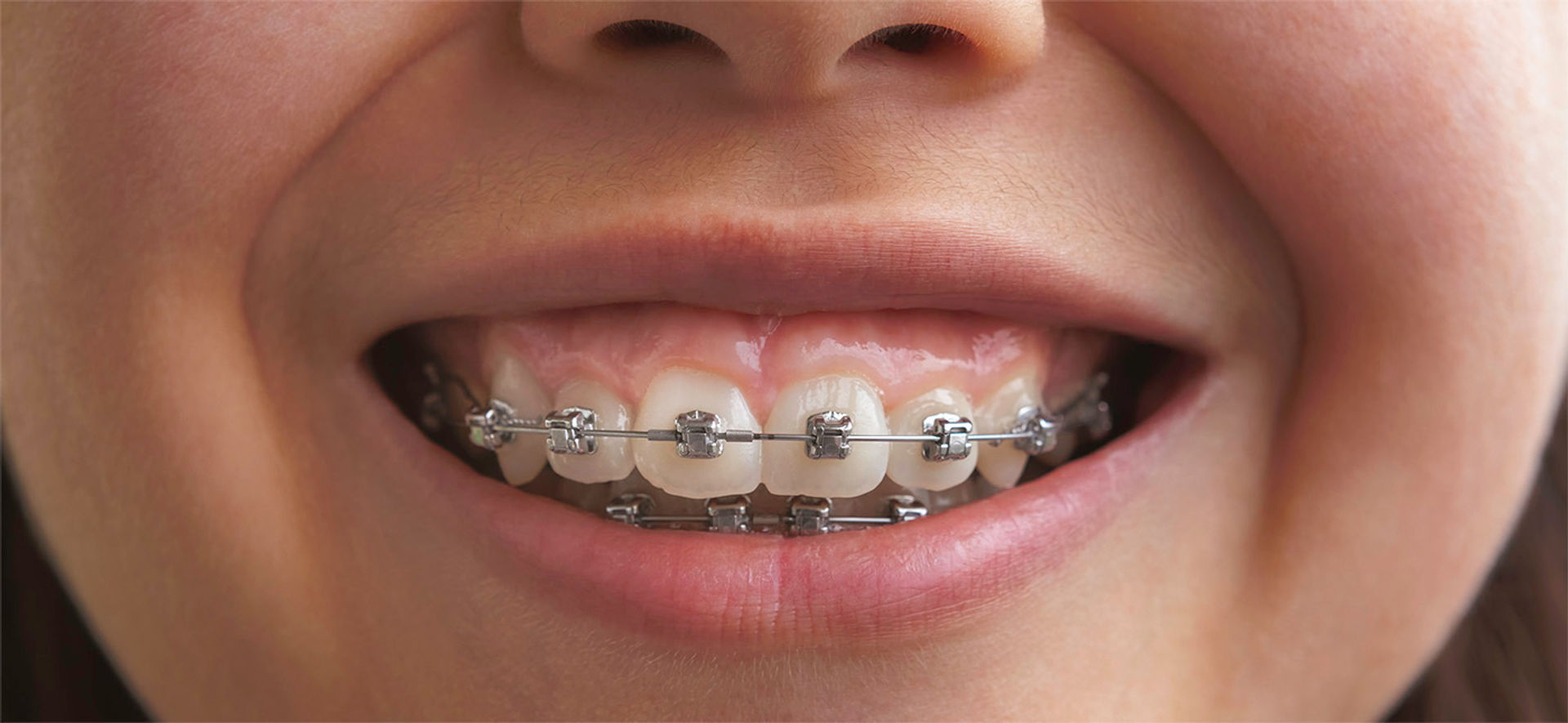braces-highlight