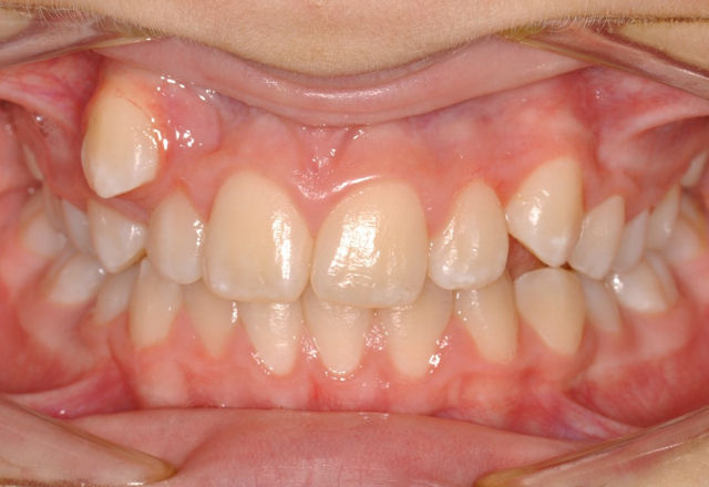 Shianne frontal before