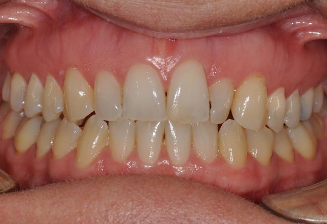 Melanie frontal before