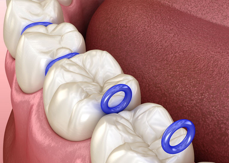 Orthodontic Separators