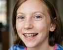 Child girl wearing orthodontic plate retainer