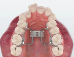 jaw expander