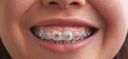 braces-highlight