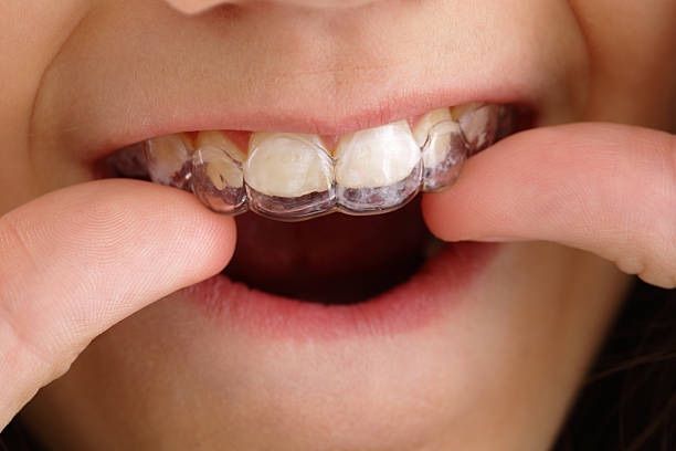 card-clear-braces-teen