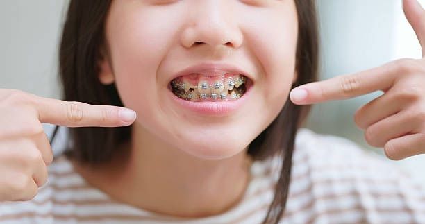 card-metal-braces-child