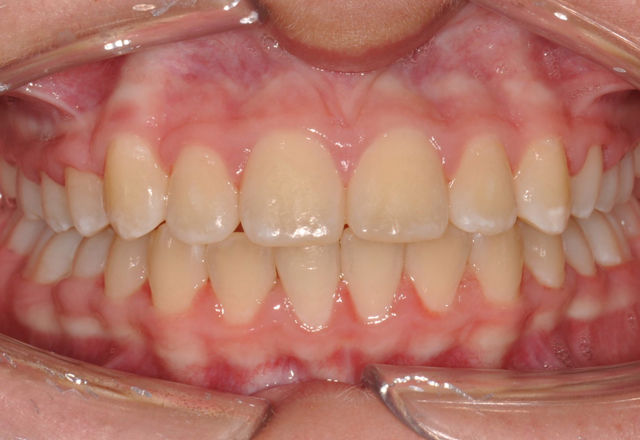 Shianne frontal final