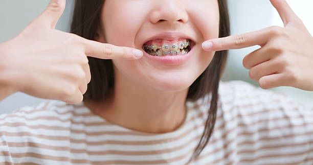 guide-braces-faq