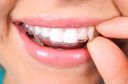treatment-clear-aligners