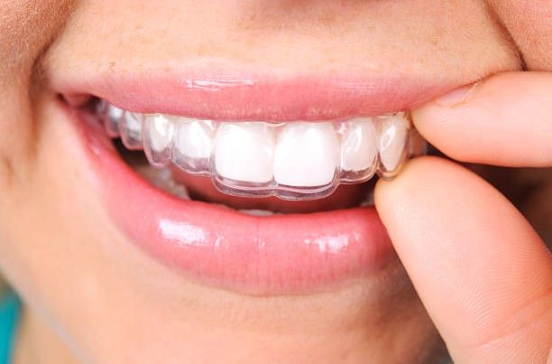 treatment-clear-aligners