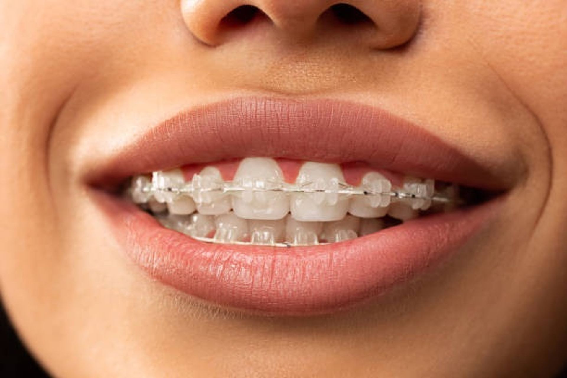 treatment-clear-braces