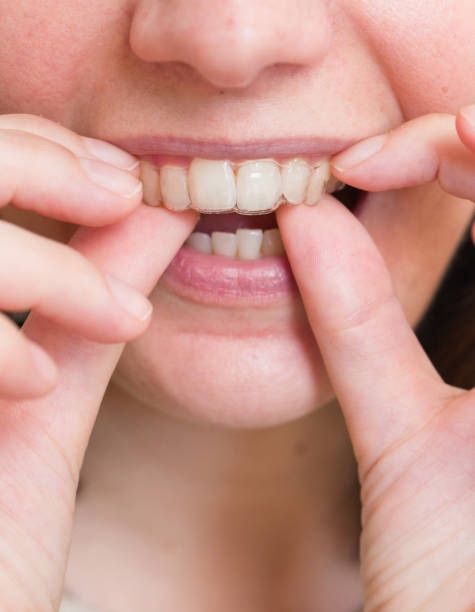 treatment-retainers