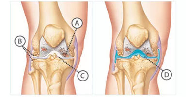 Knee Pain Treatment in NYC