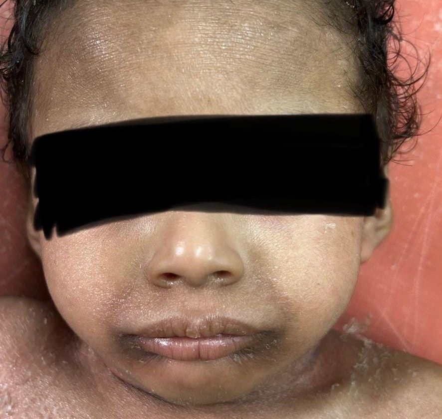 After Congenital Ichthyosiform Erythroderma Treatment