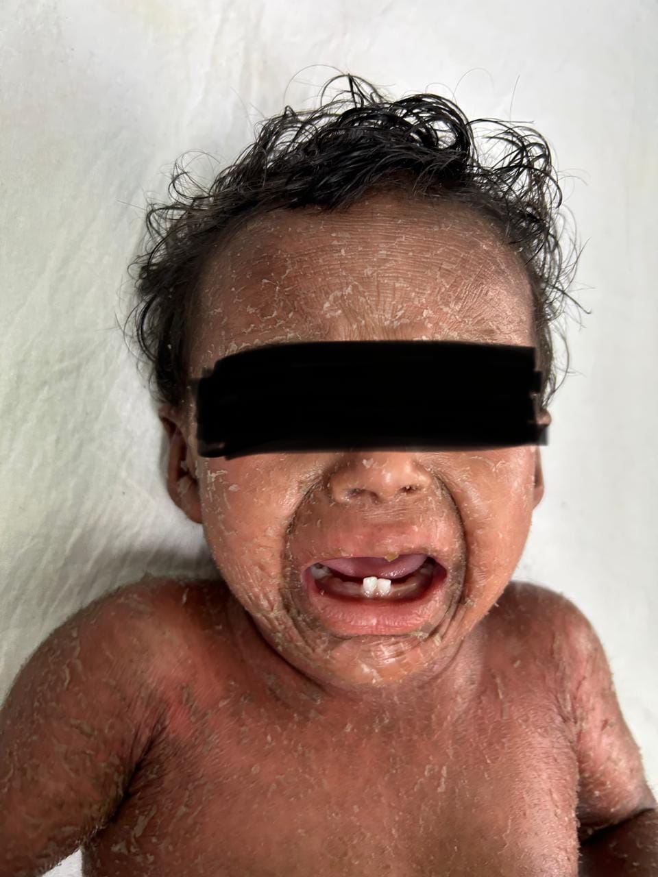 Before Congenital Ichthyosiform Erythroderma Treatment