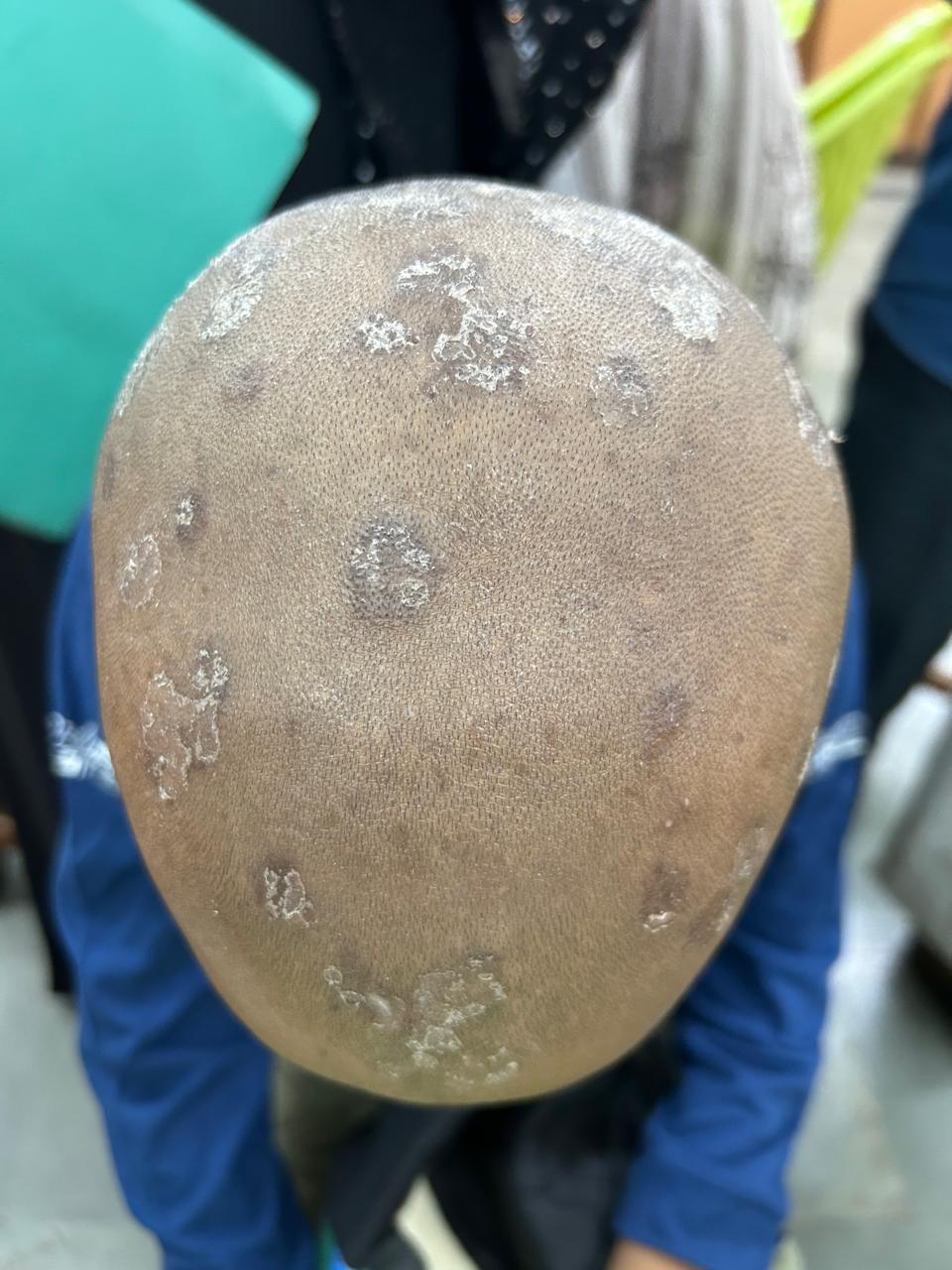 After Scalp Fungal Treatment