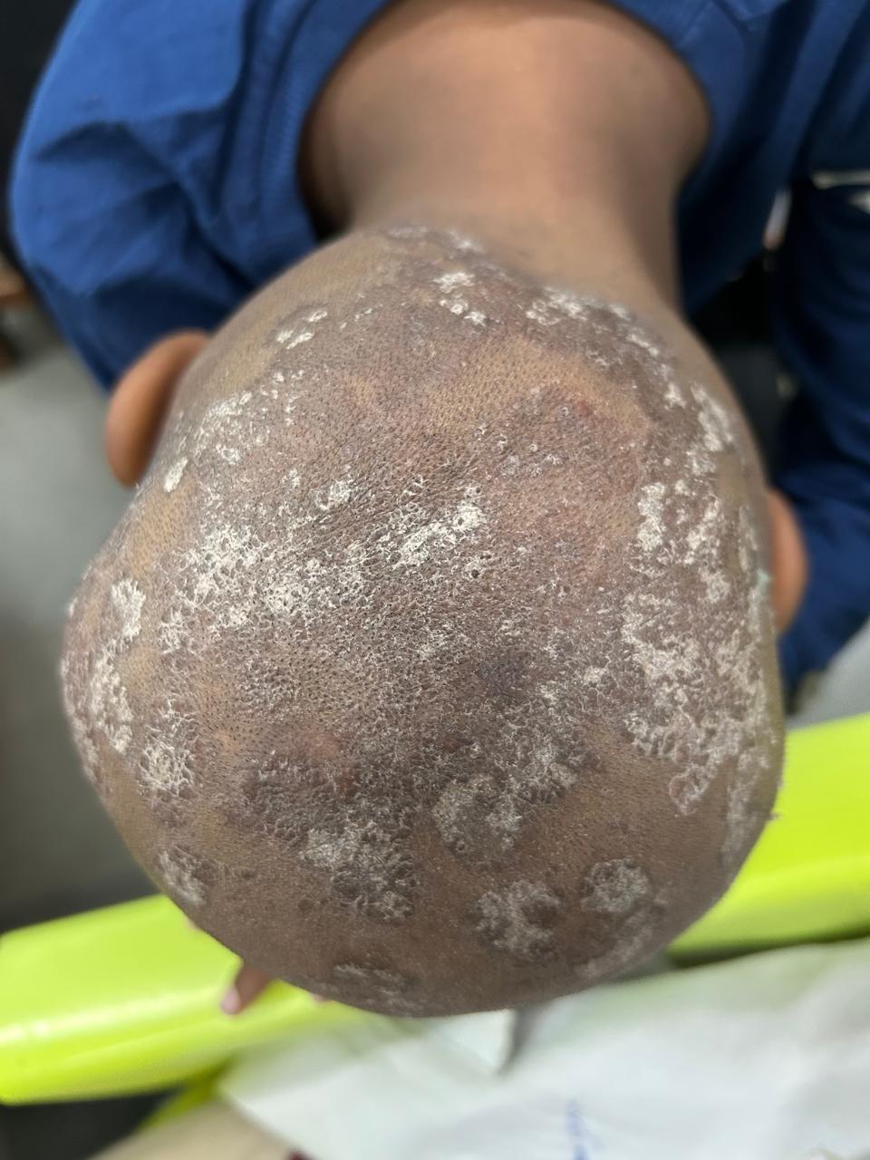 Before Scalp Fungal Treatment