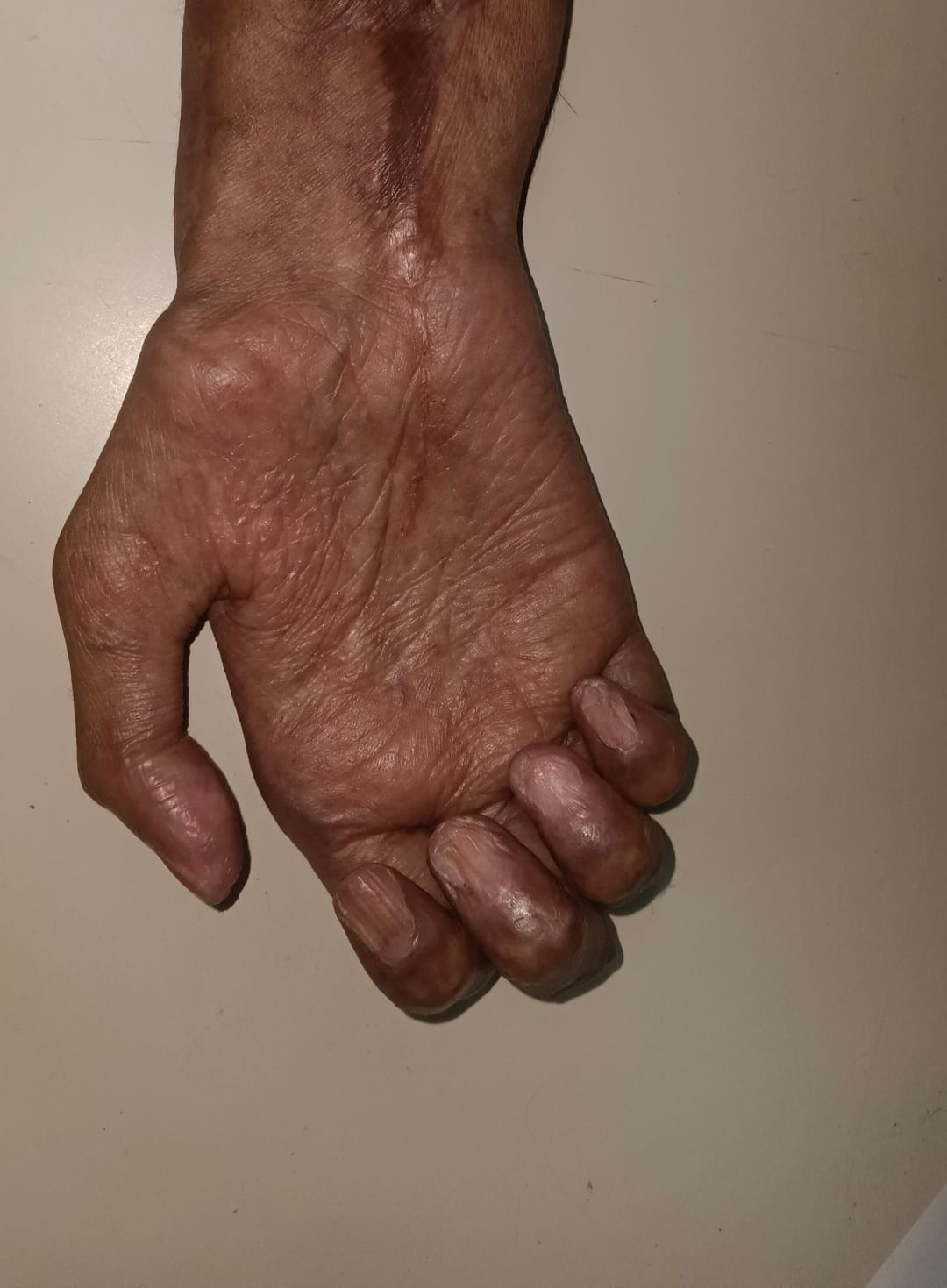 After Graft Reaction Treatment