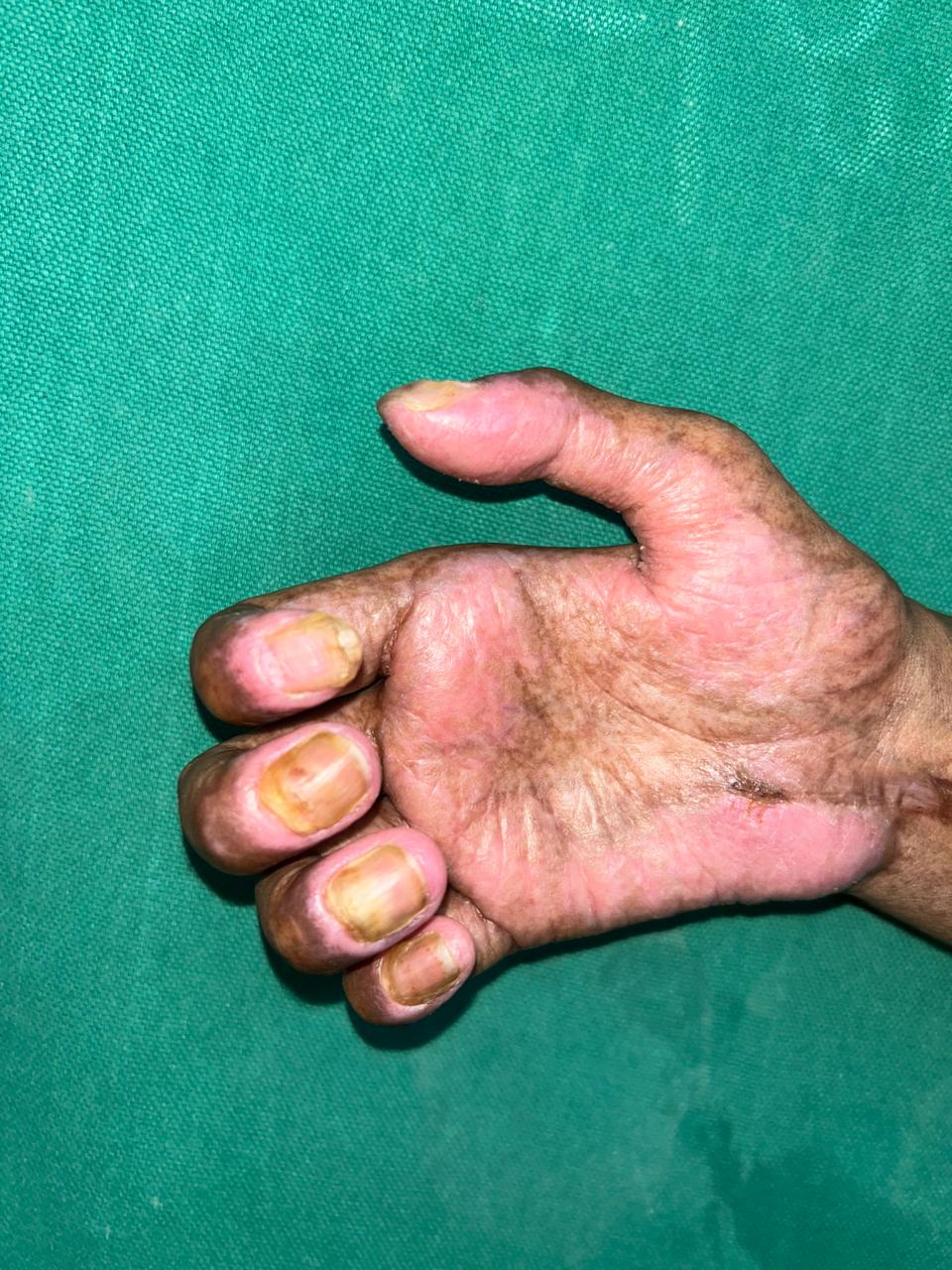 Before Graft Reaction Treatment