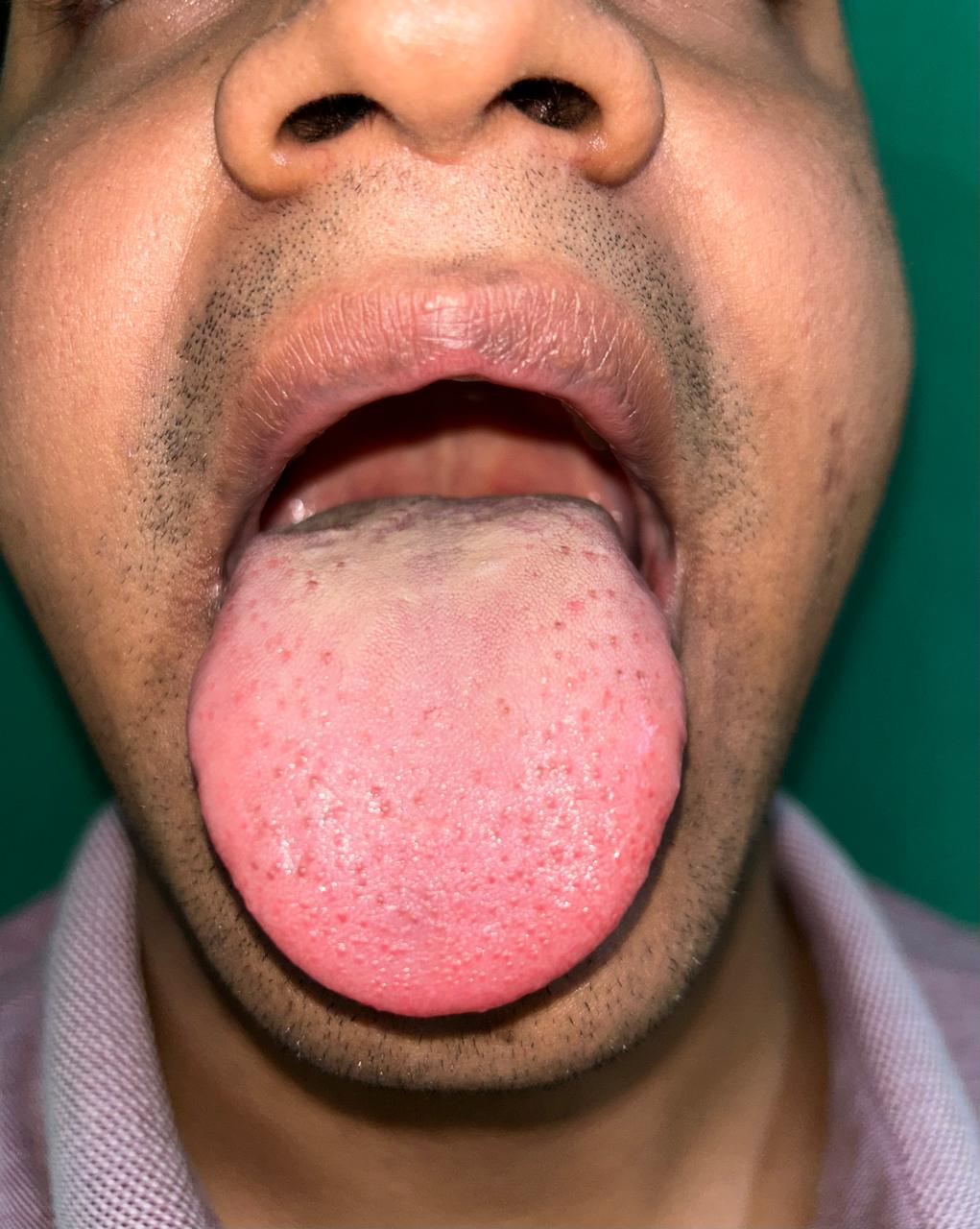 After Syphilis Treatment