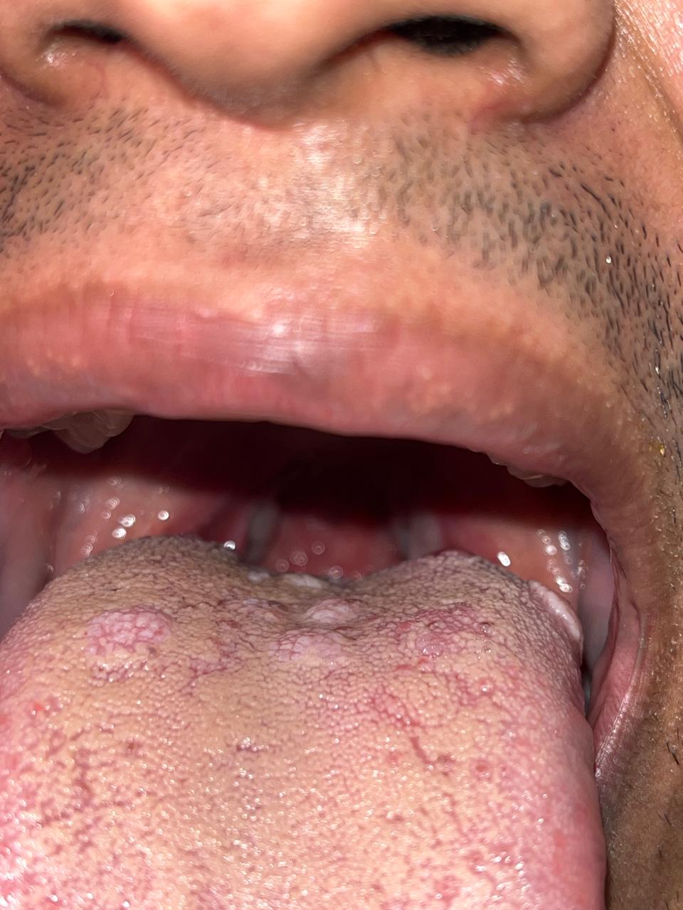 Before Syphilis Treatment