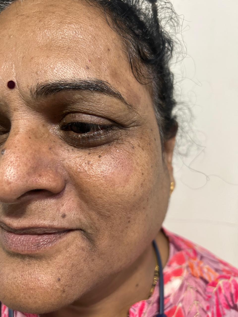 After Seborrheic Keratosis Removal