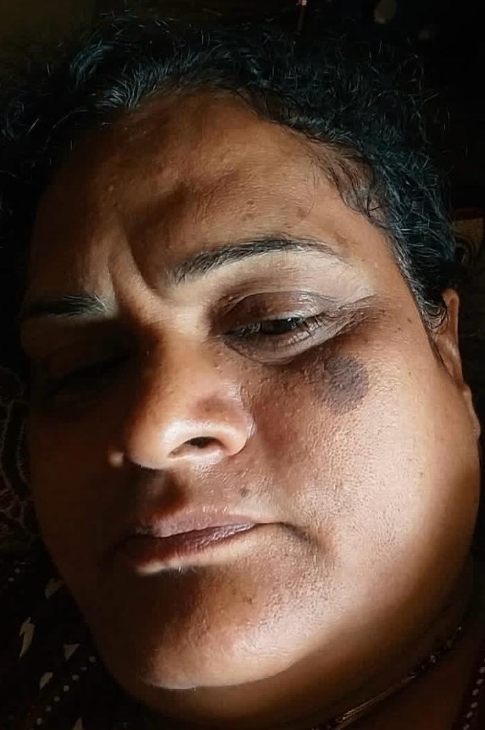 Before Seborrheic Keratosis Removal