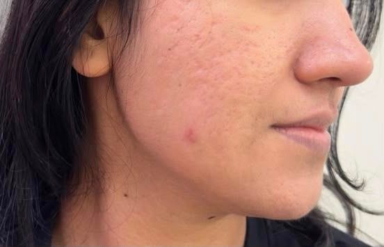 After Acne Treatment