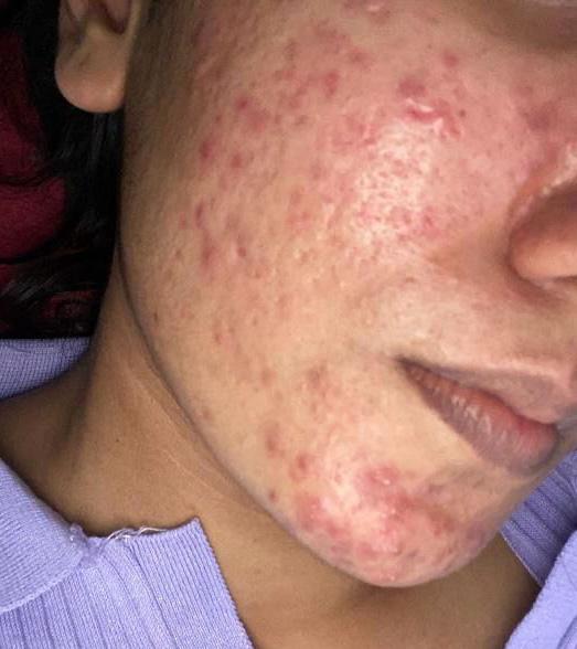 Before Acne Treatment