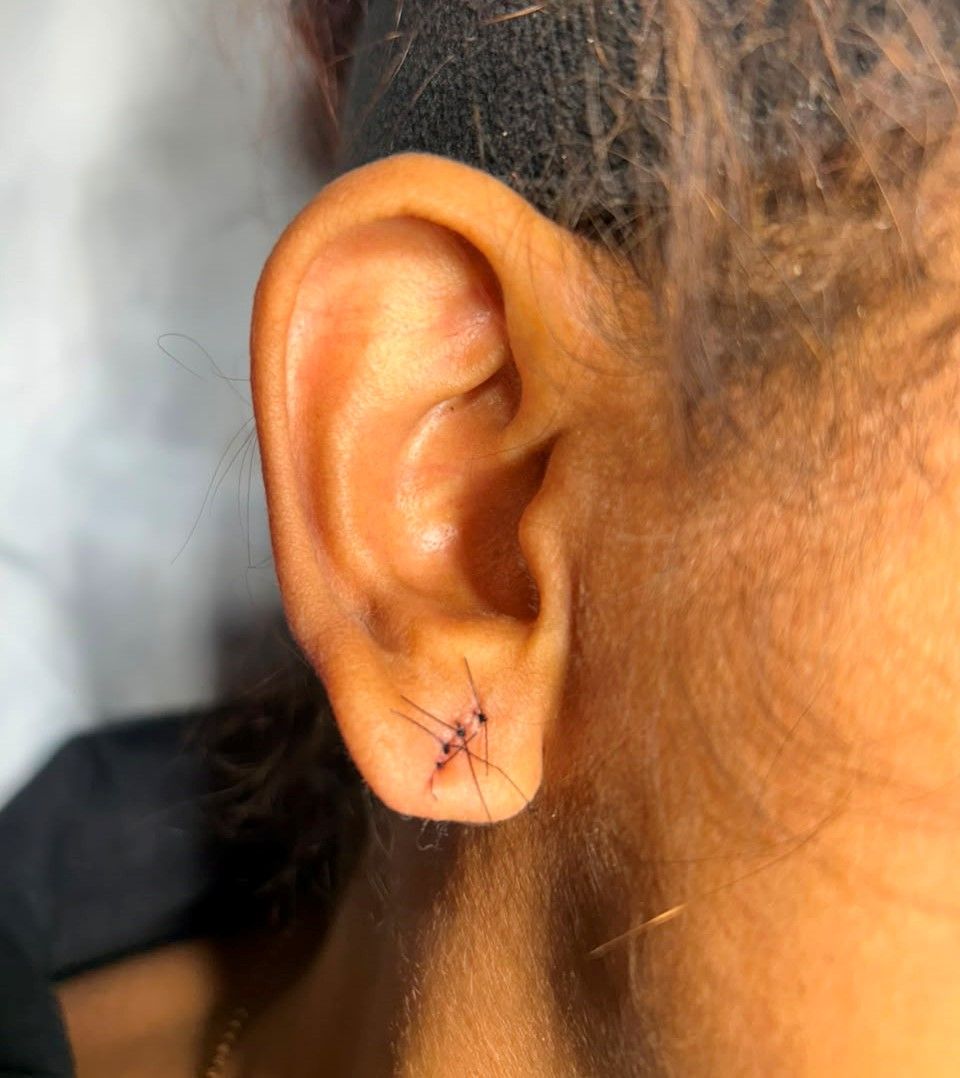 Before Earlobe Repair