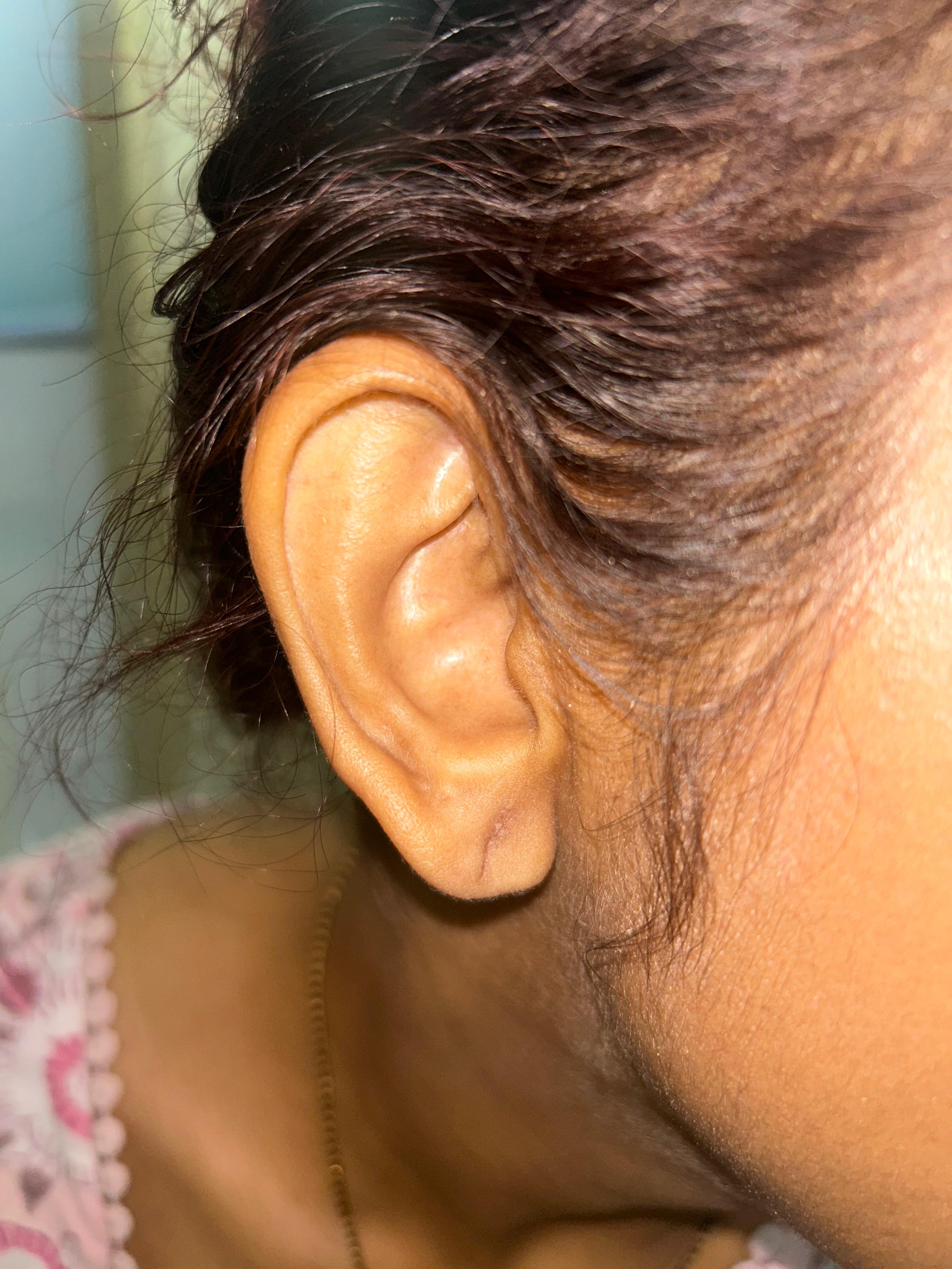 After Earlobe Repair