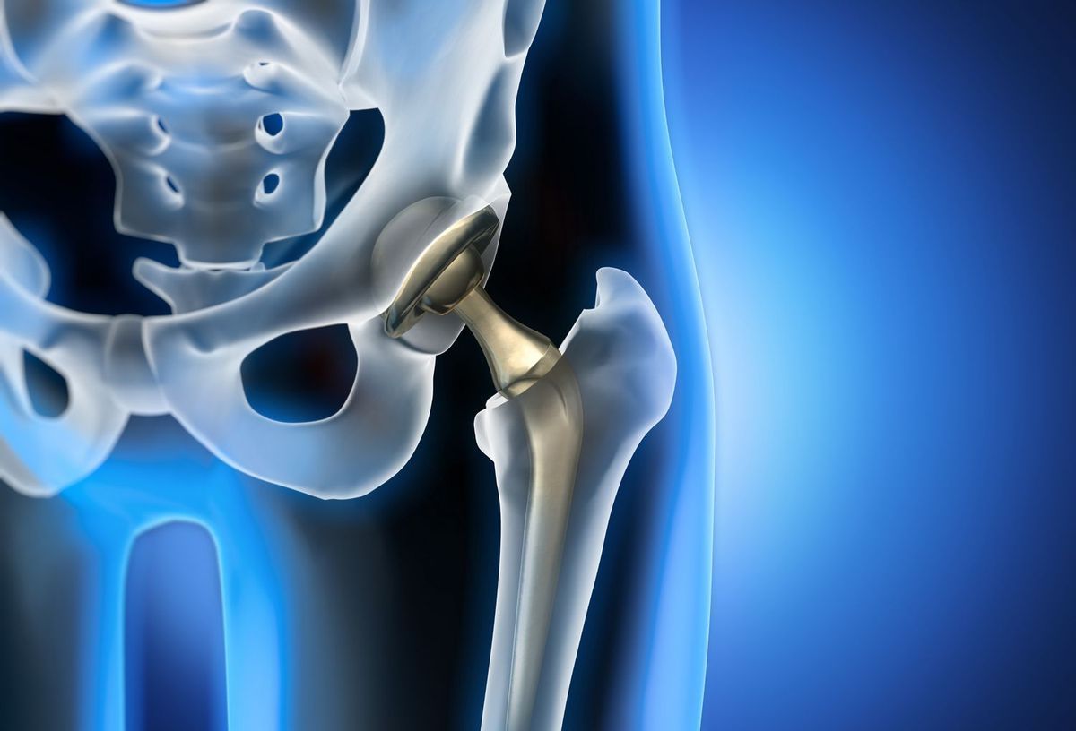 AOS Minimally Invasive Hip Replacement Procedure