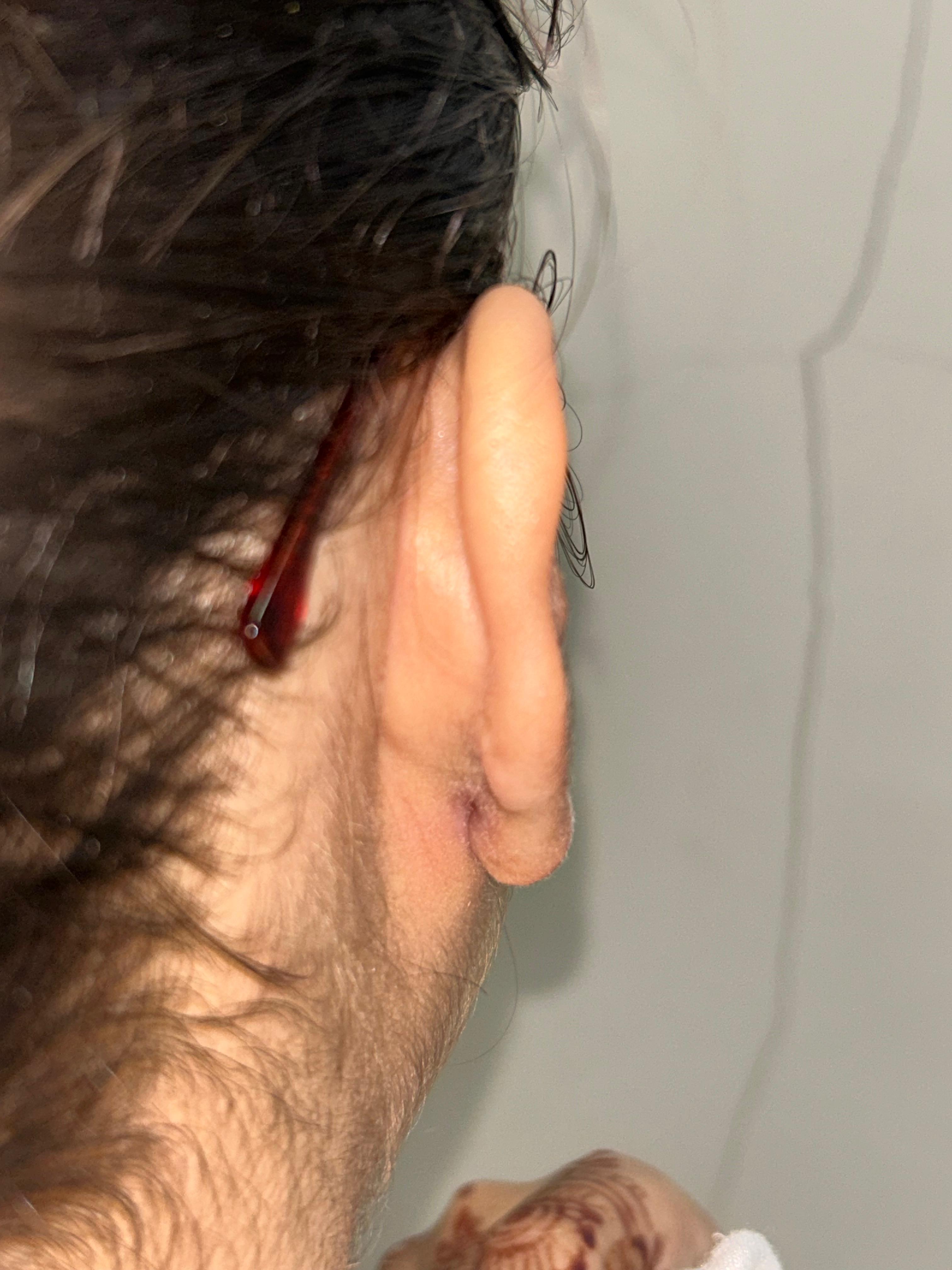 After Keloid Debulking