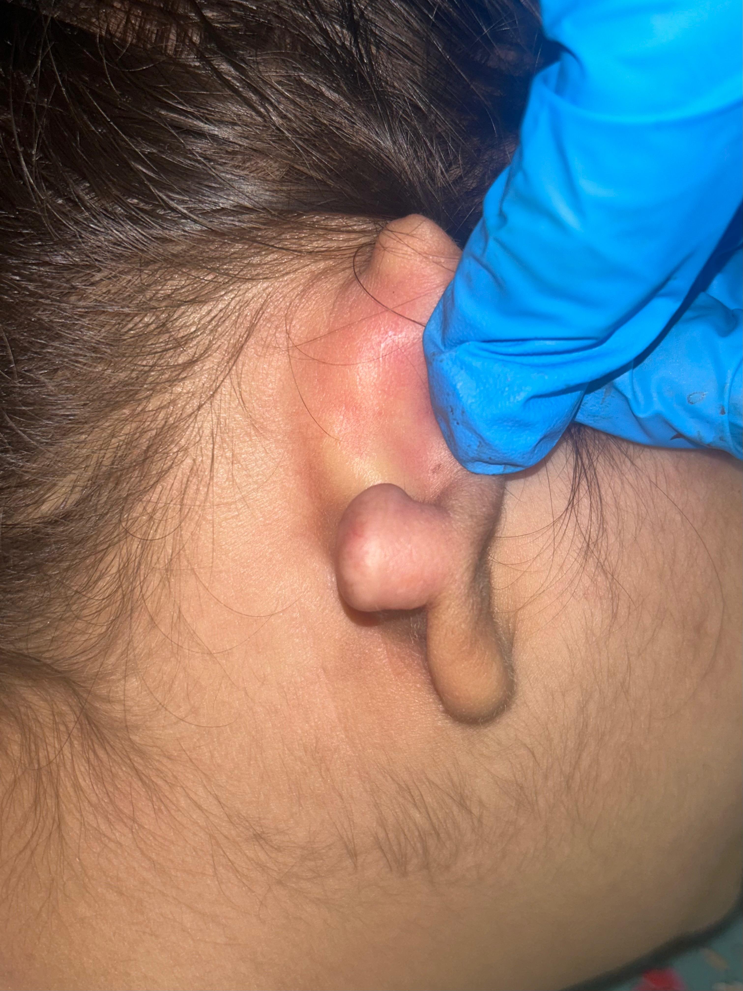 Before Keloid Debulking
