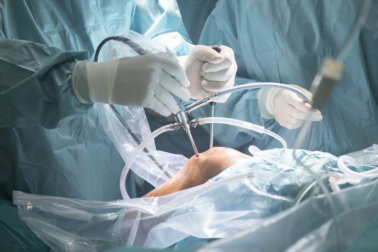 Advanced Knee Replacement Surgery