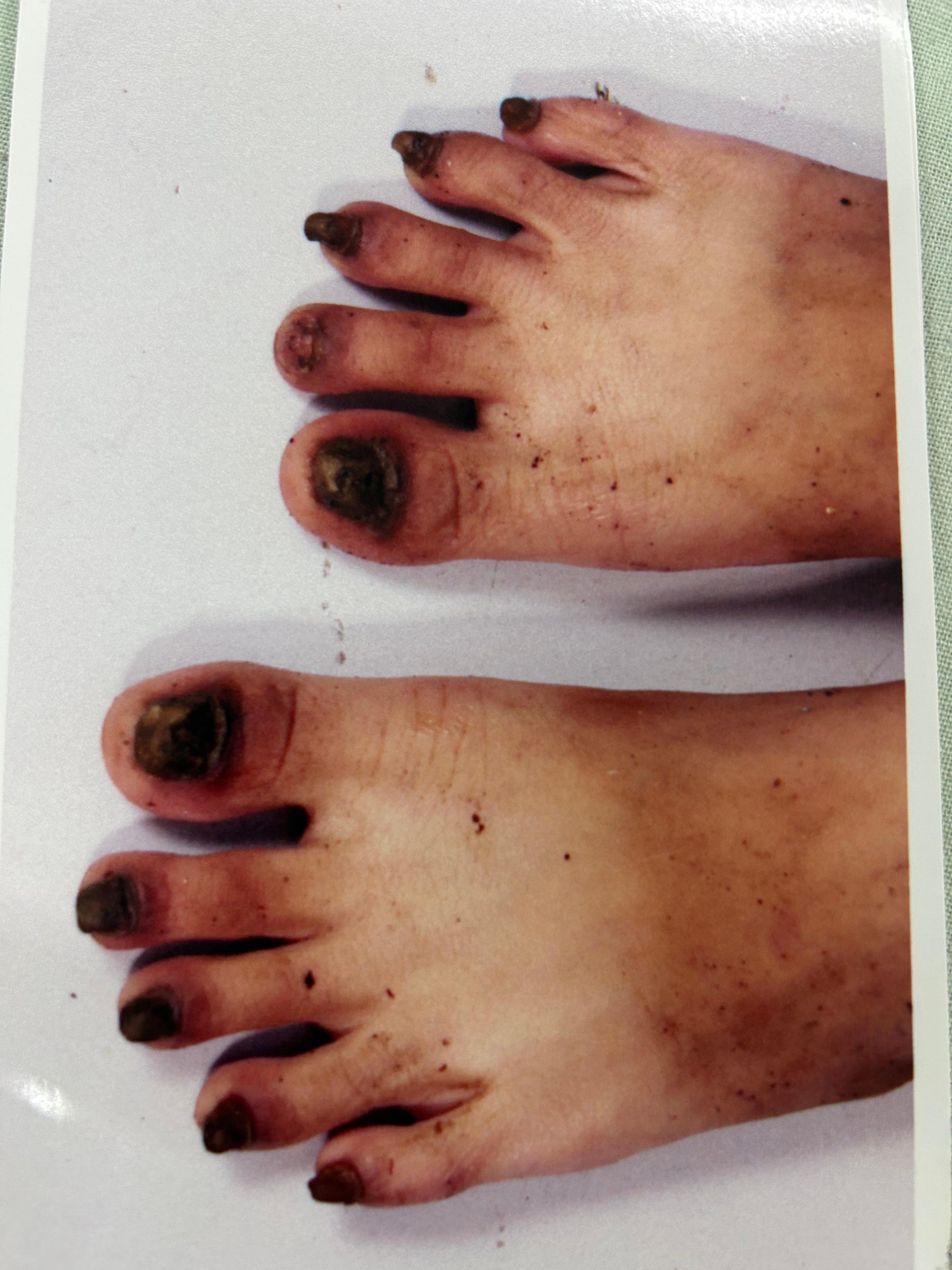 Before Nail Lichen Planus Treatment