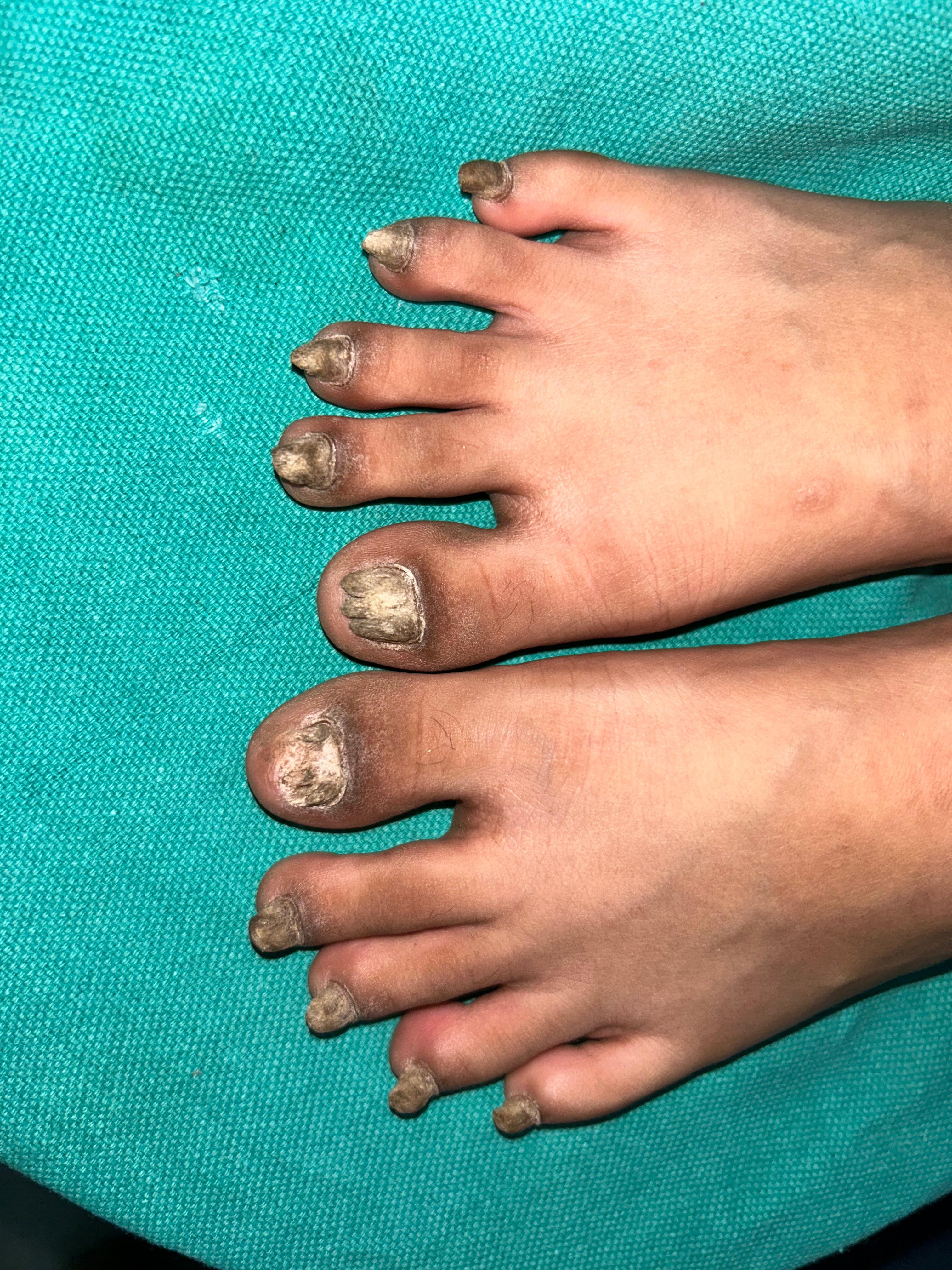 After Nail Lichen Planus Treatment